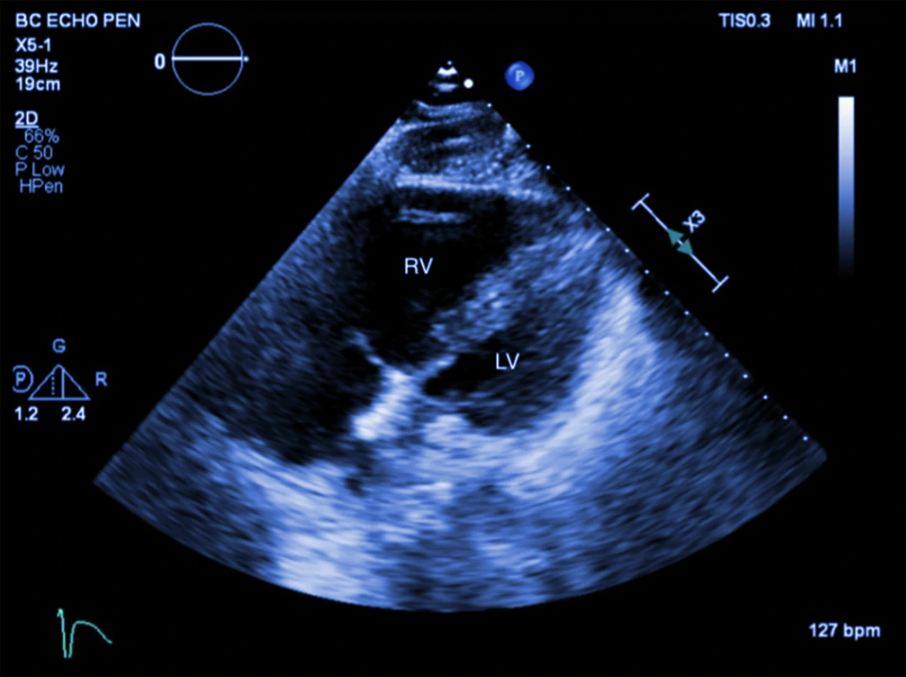 Ecocardiografía realizada a paciente para investigar la presencia de comunicación interventricular.