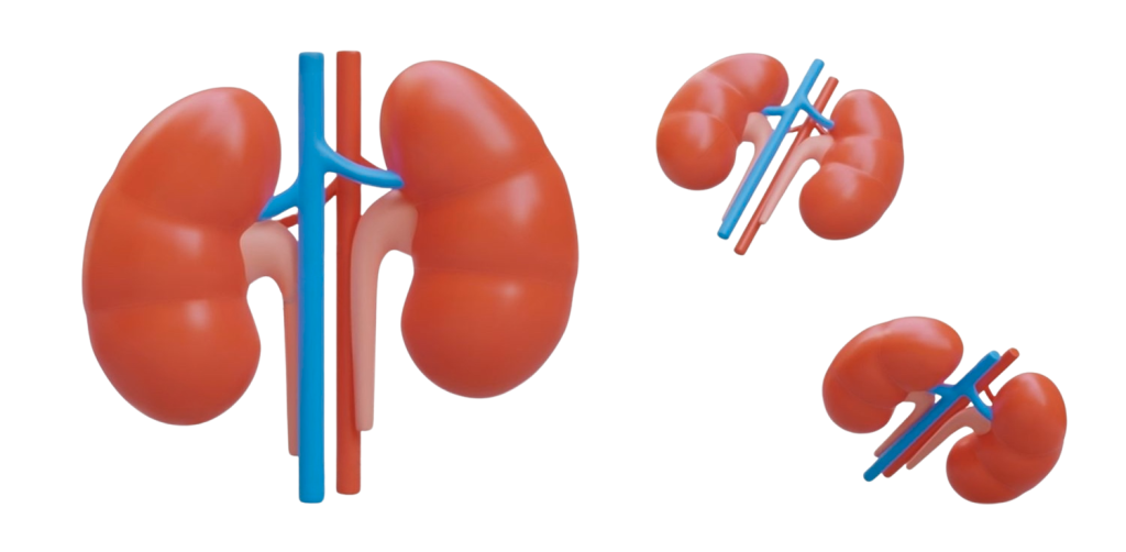 Dibujo de los riñones para representar el Síndrome de cascanueces donde se afecta la vena renal izquierda.