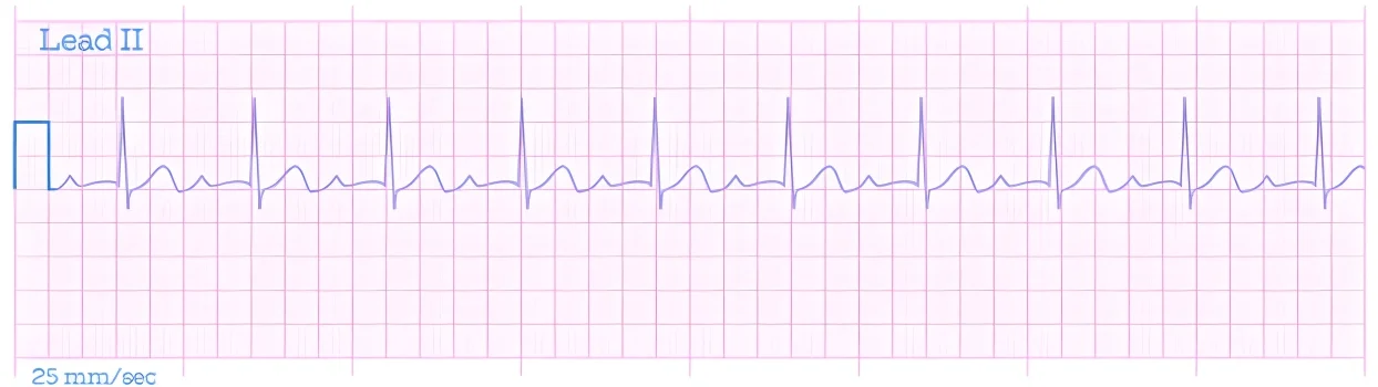 Ilustración de taquicardia supraventricular identificada mediante un electrocardiograma.