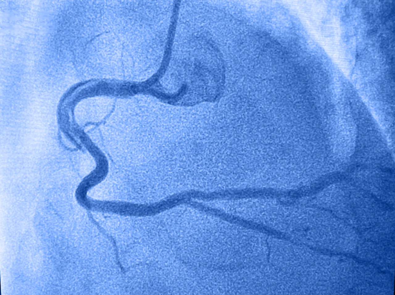 Imagen de un angiograma coronario para el diagnóstico de una disección de la arteria coronaria en un paciente. Imagen de un angiograma coronario para el diagnóstico de una disección de la arteria coronaria en un paciente.