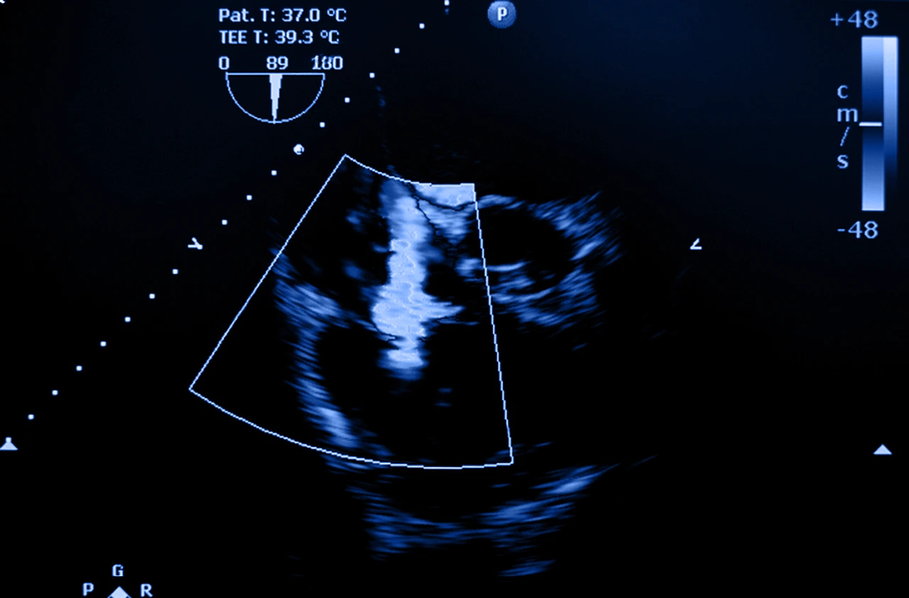 Ecocardiograma para identificar la presencia de insuficiencia tricúspidea por regurgitación de la válvula tricuspídea.