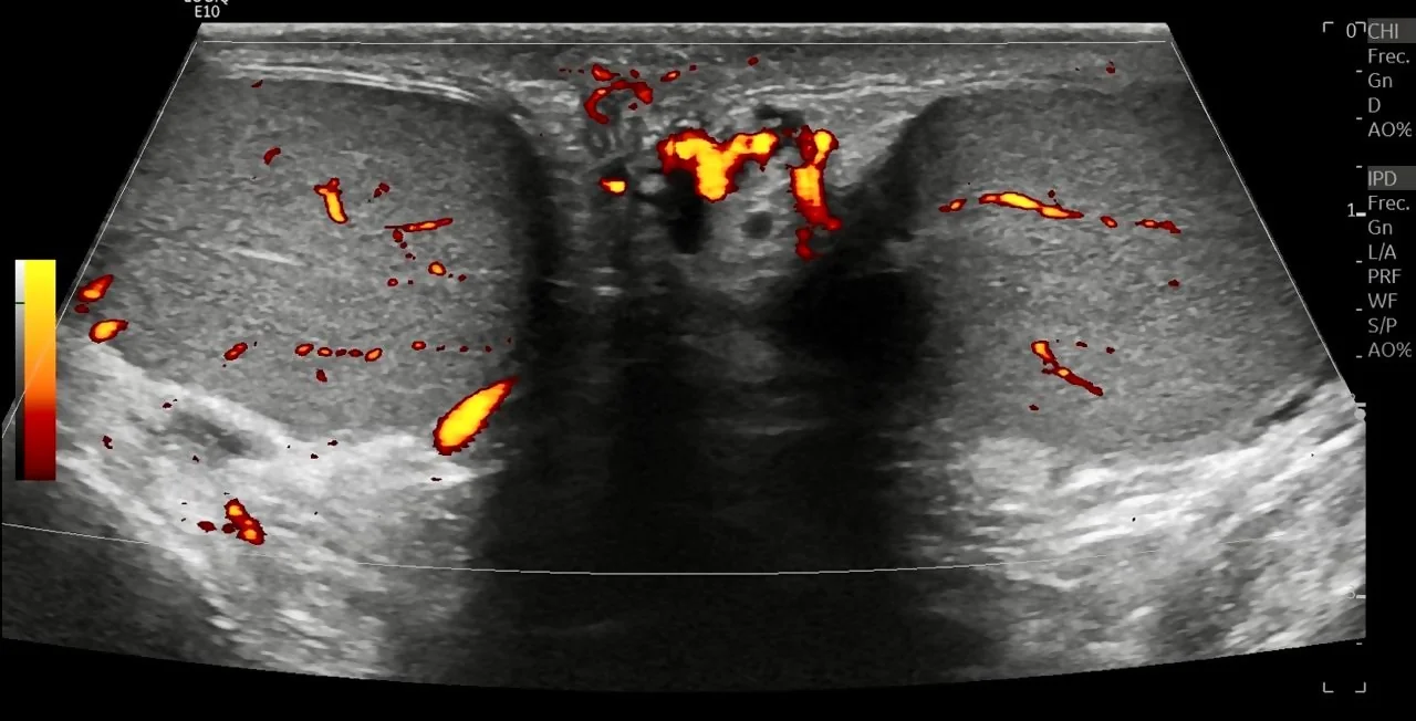 Ultrasonido testicular con doppler