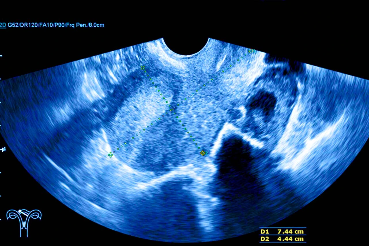 Imagen de un ultrasonido transvaginal como método diagnóstico para detectar una fístula rectovaginal.