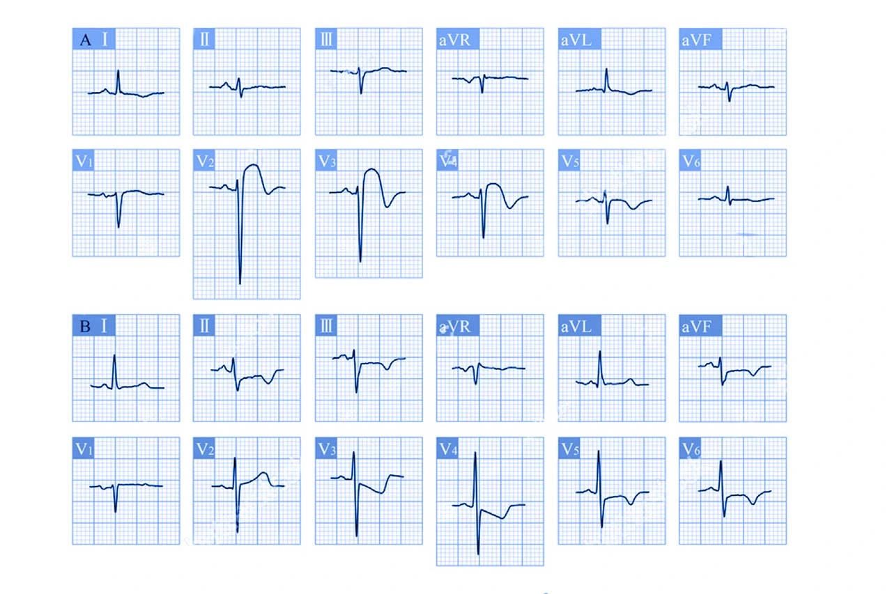 Imagen de estudio para el síndrome coronario agudo, donde se visualiza tanto la elevación del segmento ST como la depresión del segmento ST.