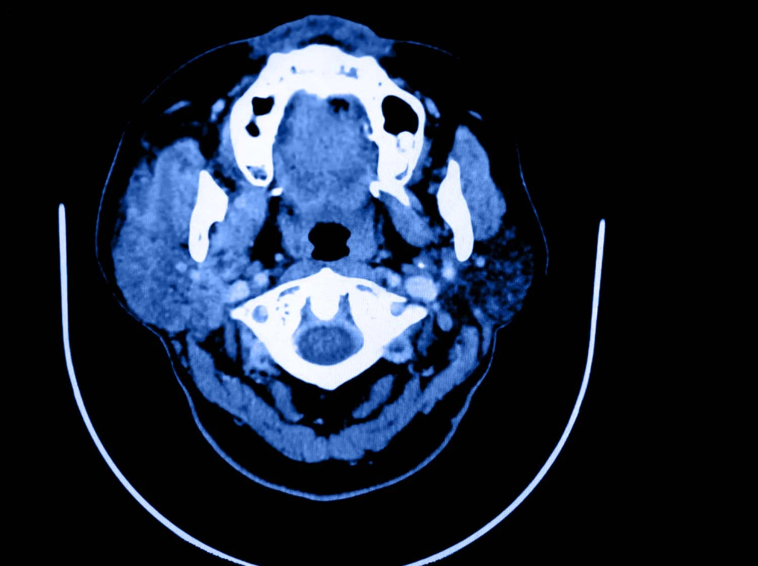 Resonancia magnética de paciente con adenoma pleomorfo, donde se visualiza crecimiento de la glándula parotídea. Resonancia magnética de paciente con adenoma pleomorfo, donde se visualiza crecimiento de la glándula parotídea.