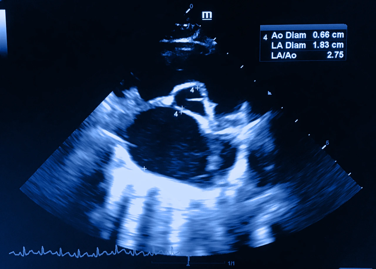 Ecocardiograma para diagnosticar la presencia de miocardiopatía hipertrófica en un paciente.
