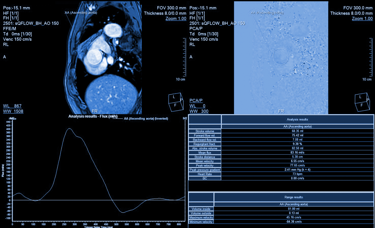 Métricas obtenidas en una prueba de esfuerzo cardiopulmonar, para un paciente donde se analizan los patrones de flujo sanguíneo y función cardíaca.