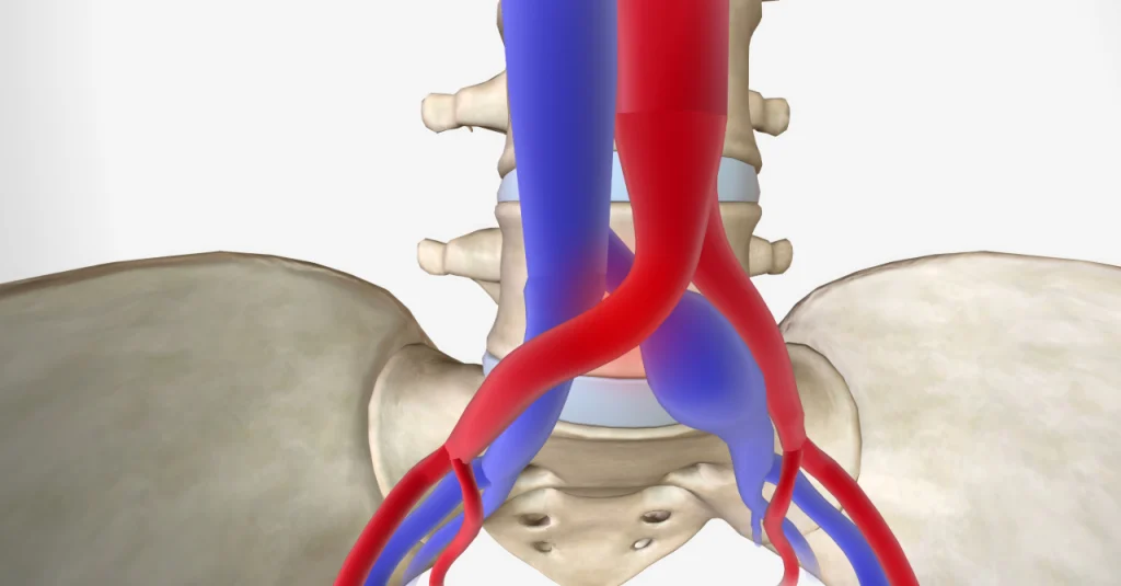 Síndrome de May-Thurner representado en un dibujo donde se ejemplifica la compresión de la vena ilíaca por la arteria ilíaca.
