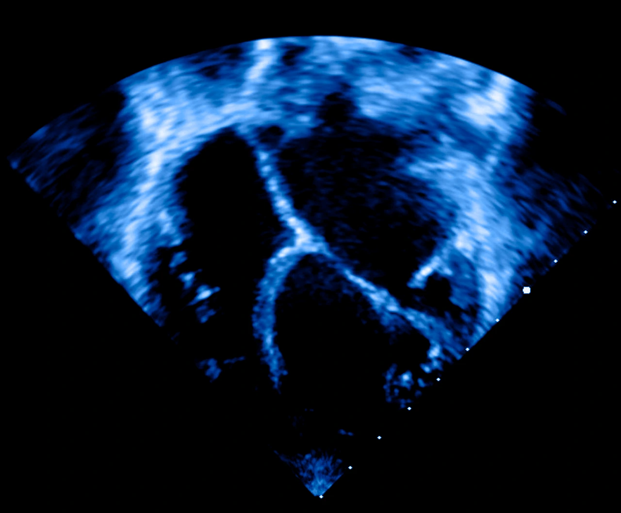 Ecocardiograma bidimensional de paciente con cardiomiopatía dilatada, donde se ve cómo está el corazón agrandado.