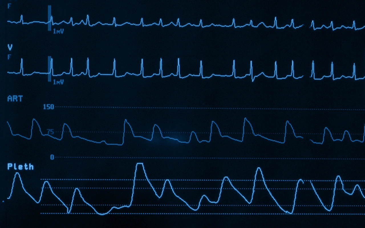 Monitor médico de ECG, con líneas donde se visualiza la presencia de fibrilación auricular en un paciente.