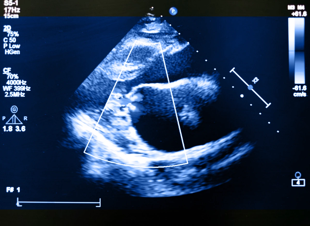 Ecocardiograma realizado a paciente para llegar al diagnóstico de la insuficiencia mitral.