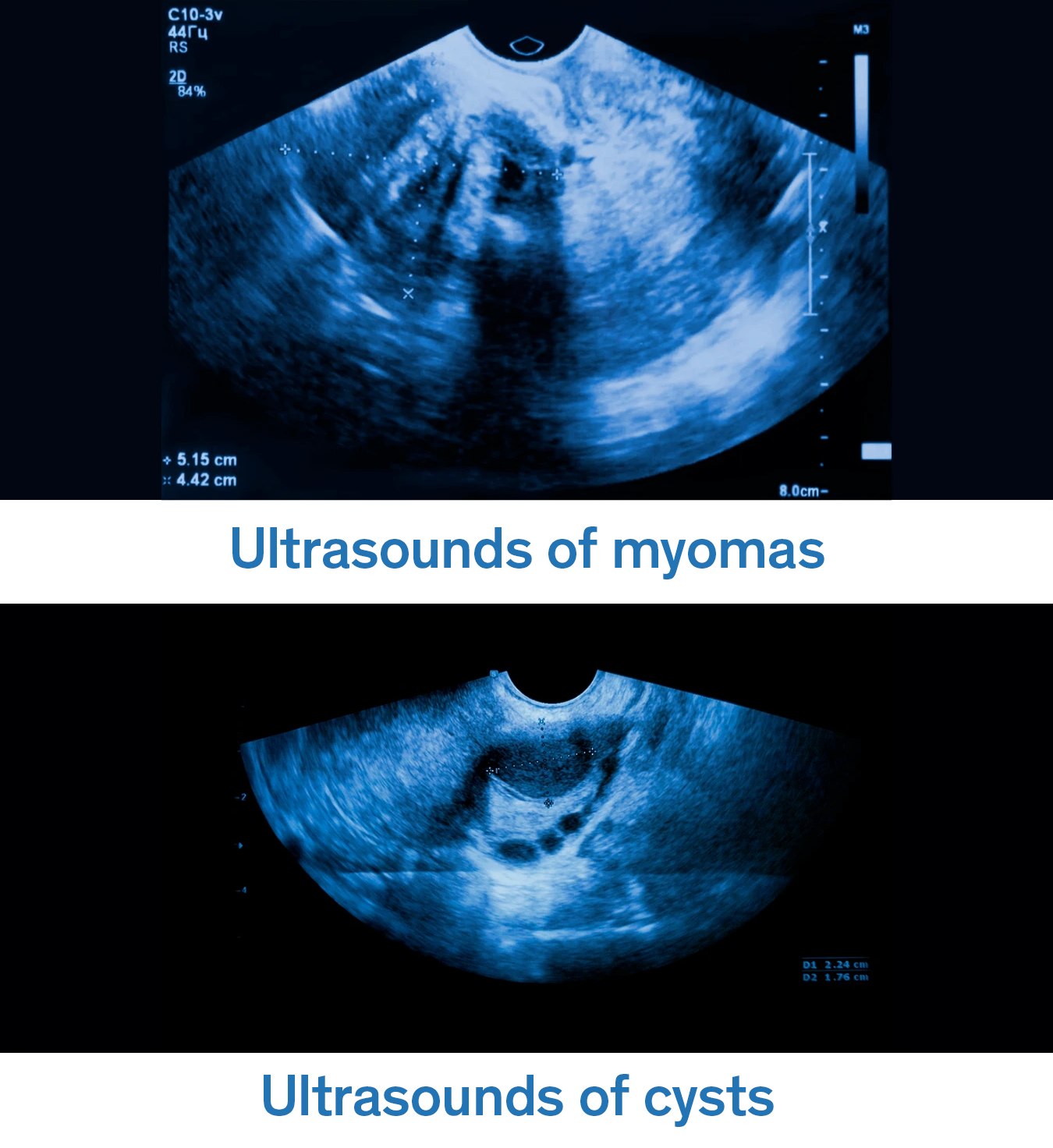 Ultrasounds of myomas and cysts for analysis and to identify the appropriate treatment for each case.