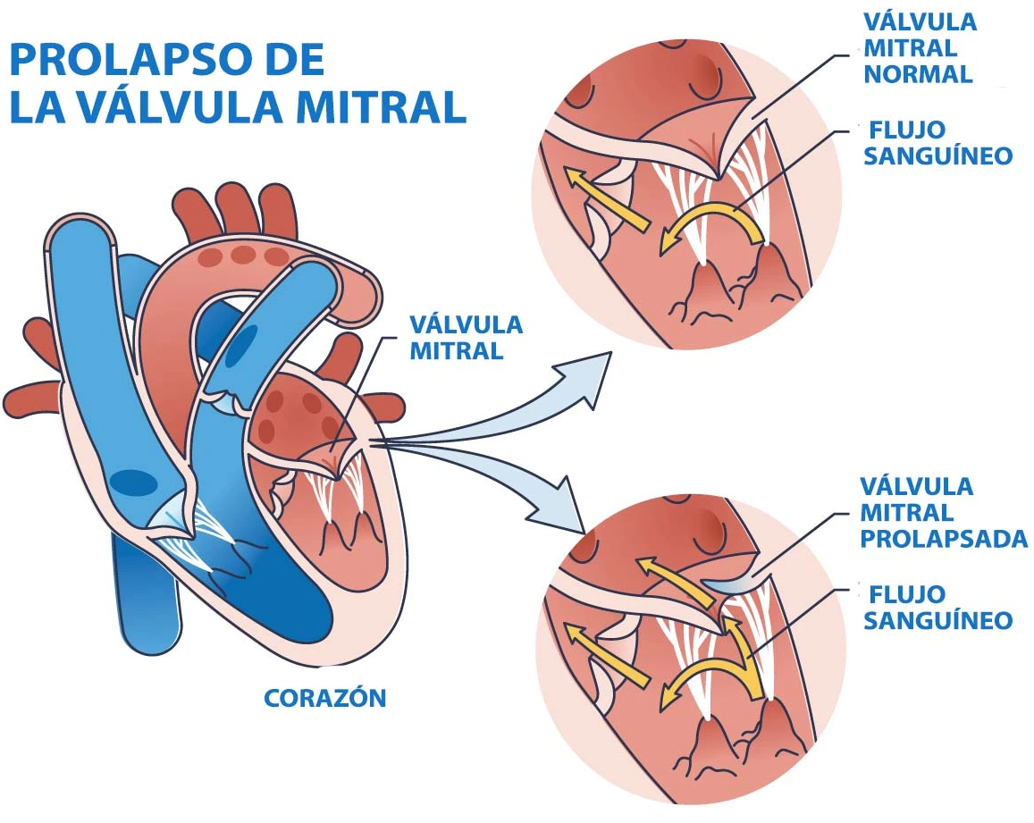Dibujo para representar el prolapso de válvula mitral con avería normal, donde se diferencia el cierre de cámara.