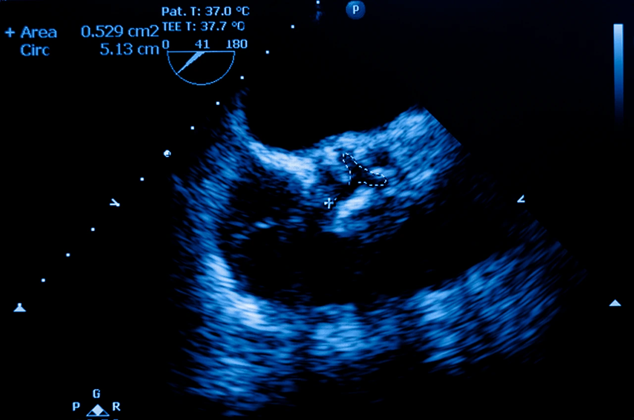 Ecocardiograma donde se visualiza la presencia de estenosis aórtica severa en un paciente.