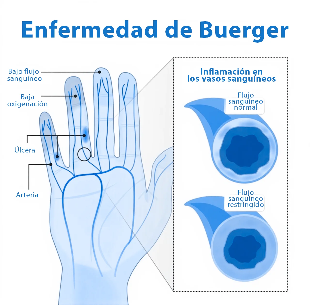 Dibujo que ejemplifica cómo la enfermedad de Buerger afecta los vasos sanguíneos de la mano de una persona. Dibujo que ejemplifica cómo la enfermedad de Buerger afecta los vasos sanguíneos de la mano de una persona.