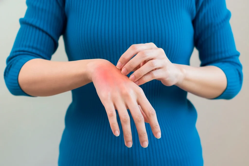 Mujer presentando alergia en la piel del dorso de la mano, se ve rojo e hinchado.