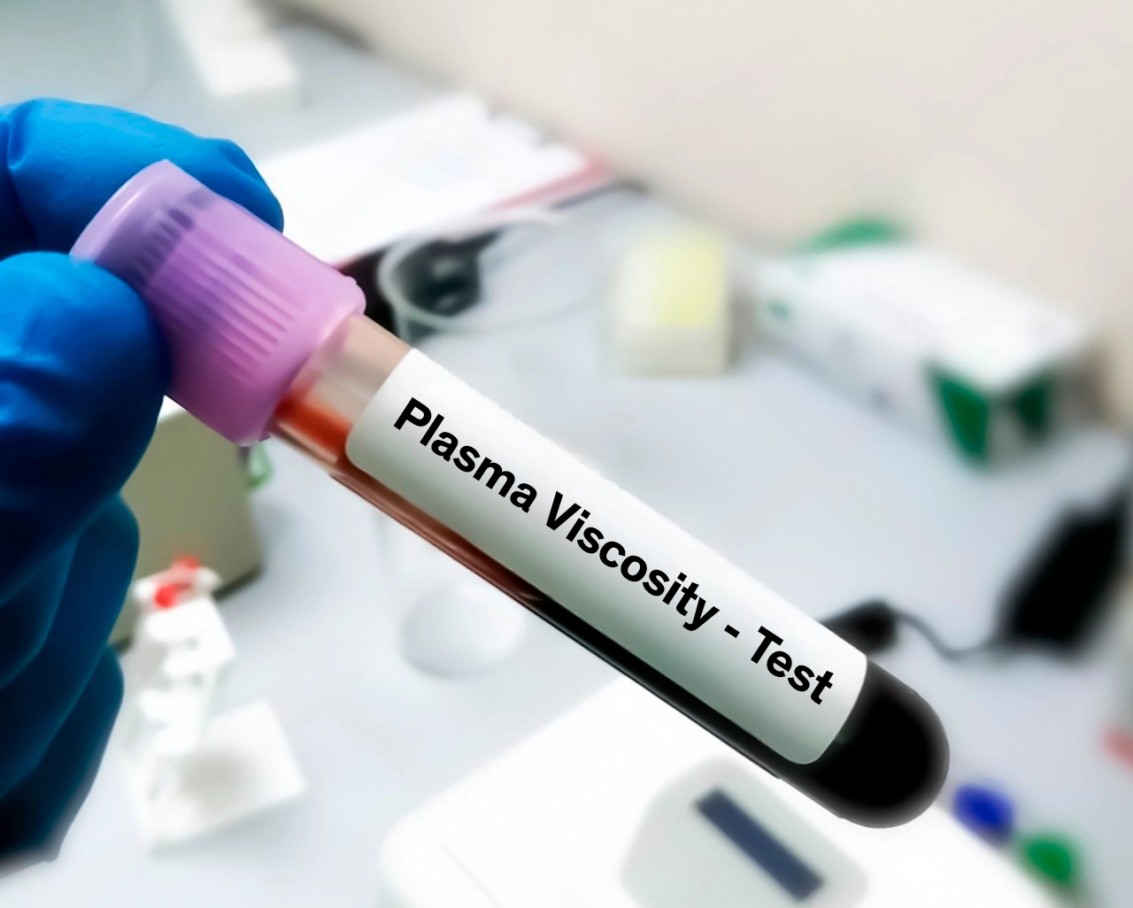 Muestra de sangre como prueba diagnóstica para la arteritis de células gigantes.