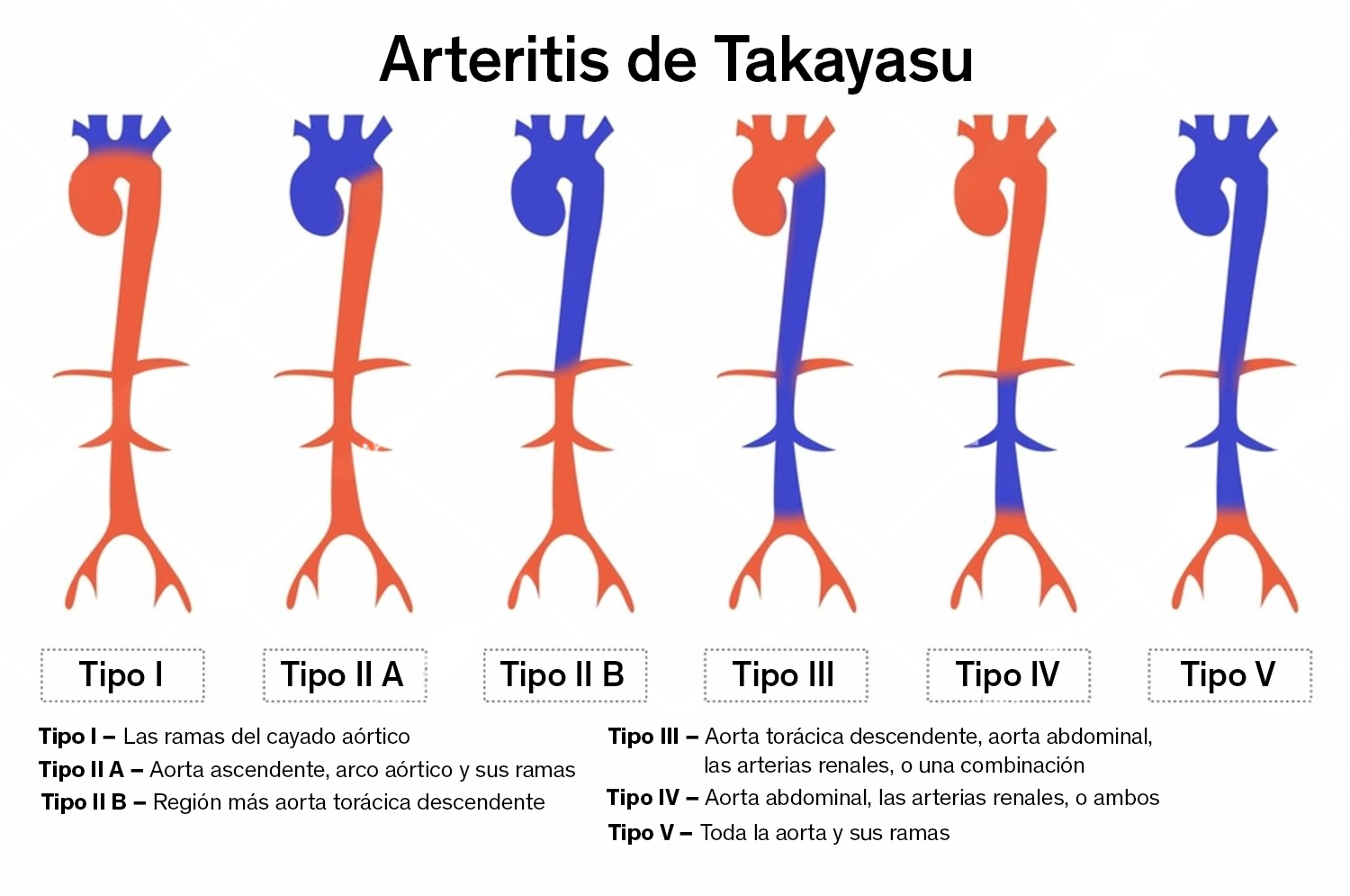 Ilustración de los diferentes tipos de Arteritis de Takayasu, en donde se muestran los seis tipos.
