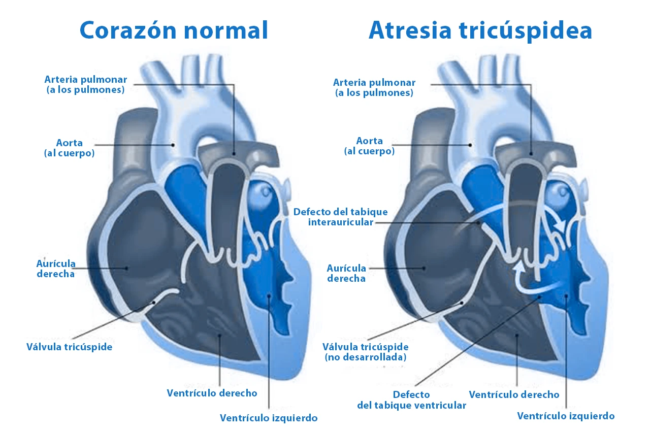 Ilustración de un corazón normal y un corazón con atresia tricúspidea donde se indican las áreas de defecto congénito.