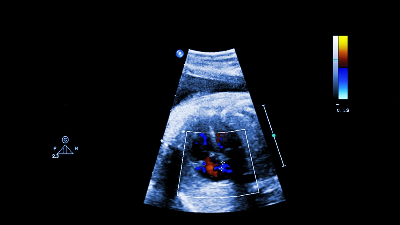 Ecocardiografía fetal realizada como método de diagnóstico para la doble salida del ventrículo derecho. Ecocardiografía fetal realizada como método de diagnóstico para la doble salida del ventrículo derecho.