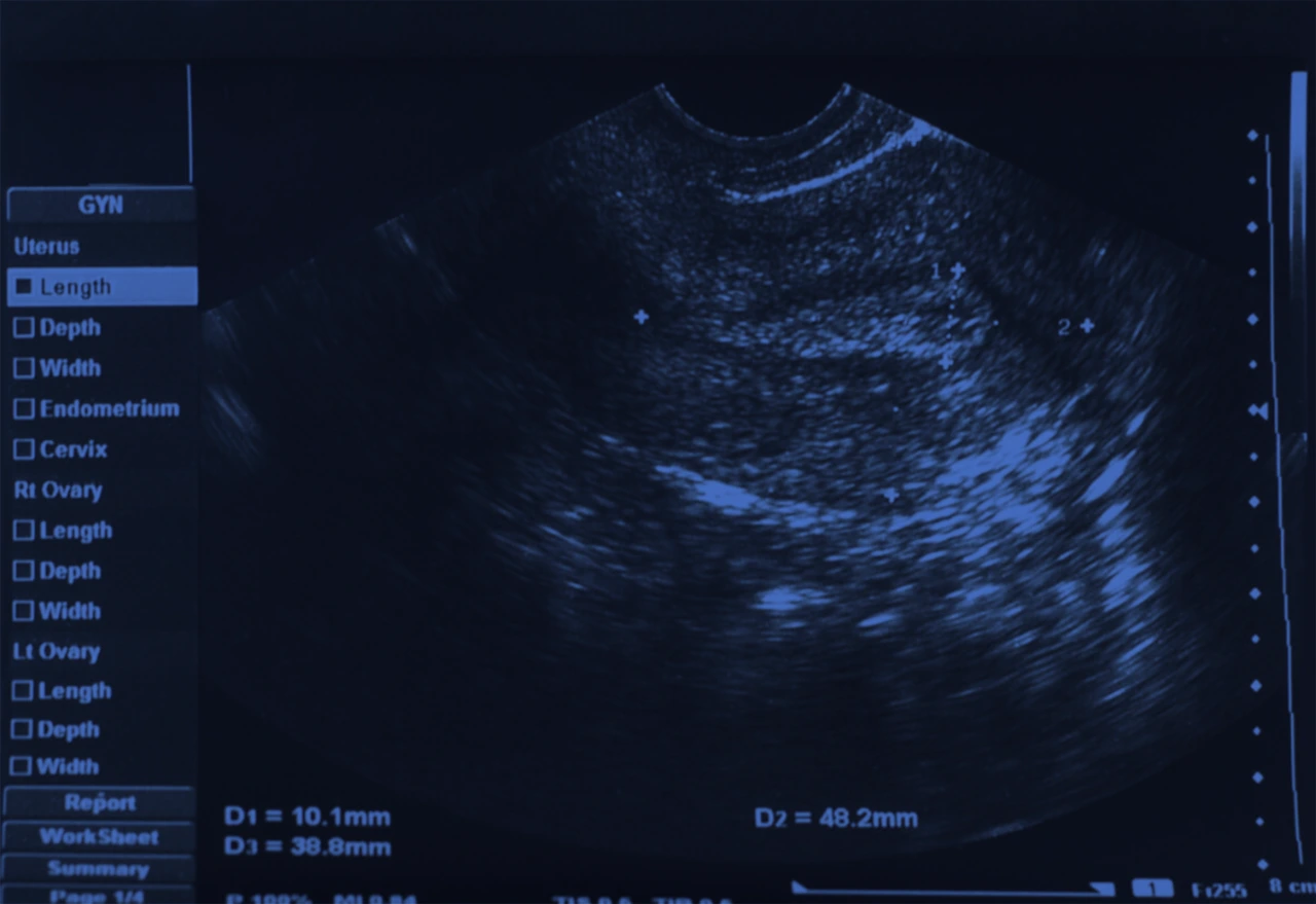 Ultrasonido pélvico como parte de los estudios diagnóstico de un tumor anexial.