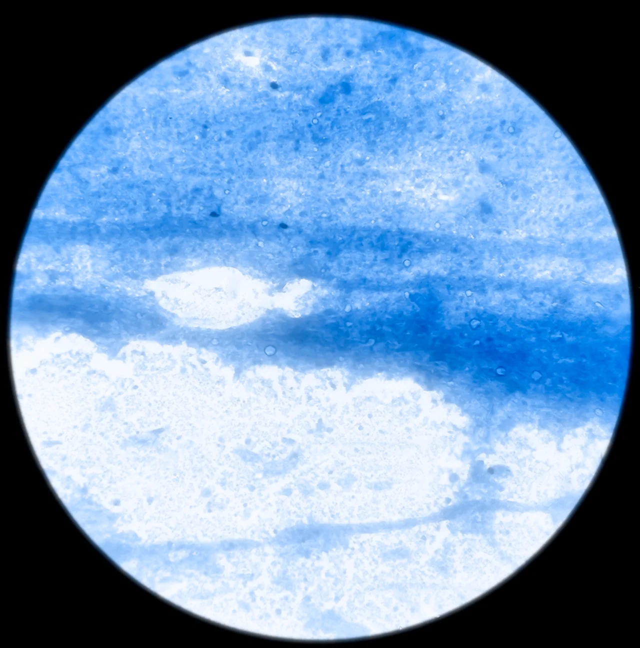 Microfotografía de un bulto mamario, que forma parte del estudio diagnóstico de la ectasia ductal. Microfotografía de un bulto mamario, que forma parte del estudio diagnóstico de la ectasia ductal.