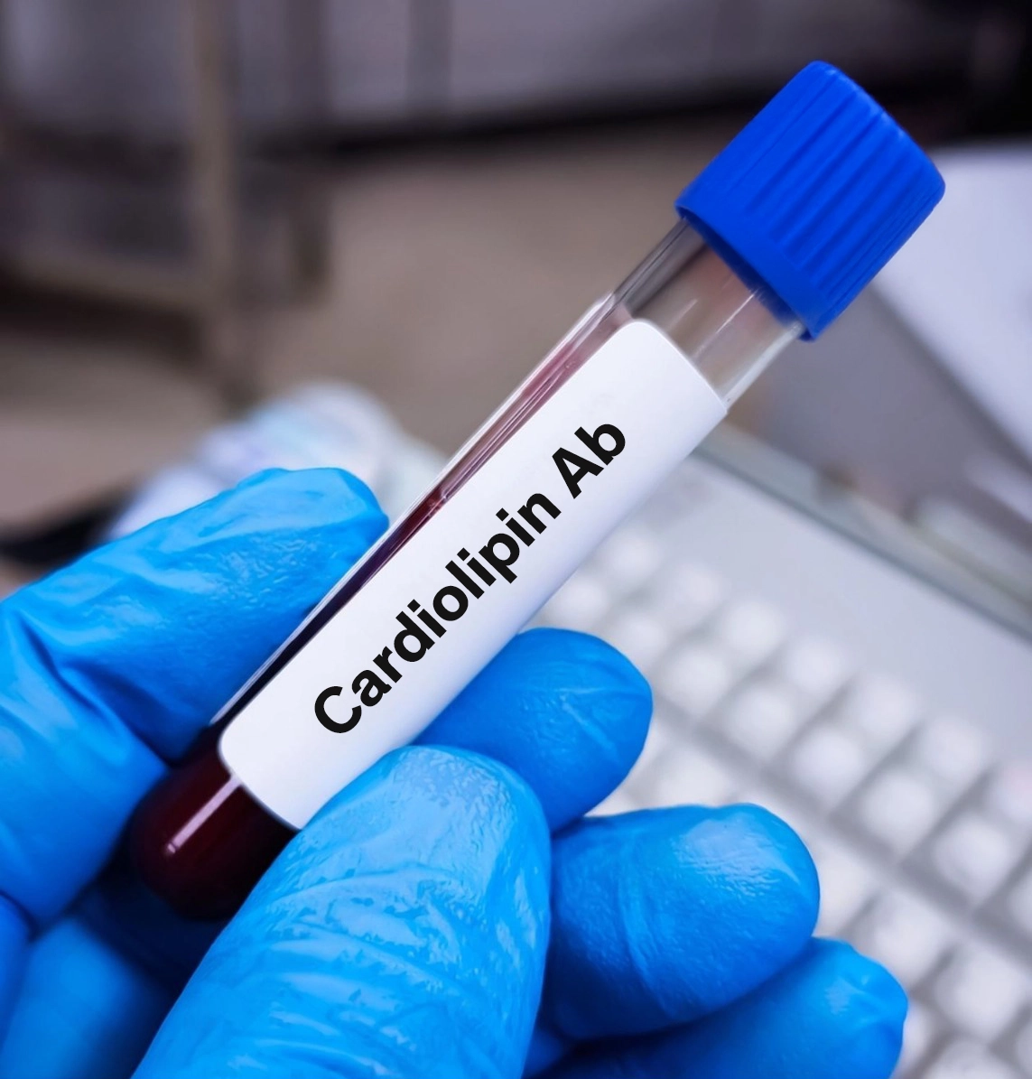 Tubo de prueba de sangre para detectar la presencia de la enfermedad de Behçet. Tubo de prueba de sangre para detectar la presencia de la enfermedad de Behçet.