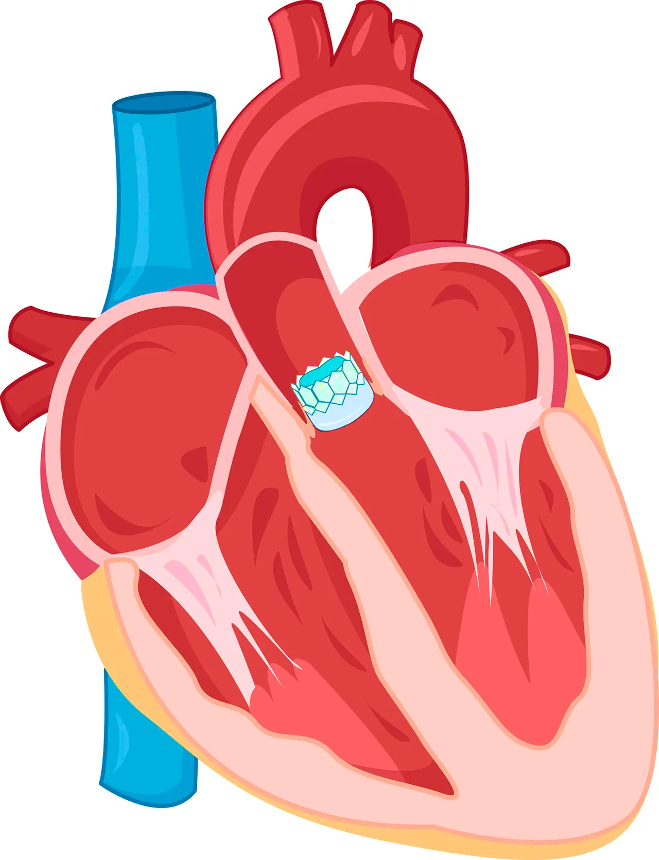 Ilustración de un corazón que muestra un implante debido a una enfermedad de la válvula pulmonar.