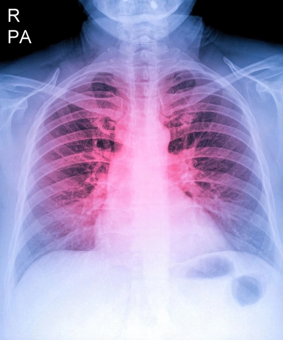 Radiografía de tórax como estudio de imagen que ayuda en el diagnóstico de la hipertensión pulmonar. Radiografía de tórax como estudio de imagen que ayuda en el diagnóstico de la hipertensión pulmonar.