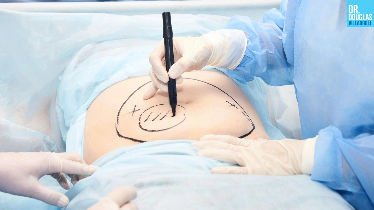 Médicos realizando marcación en el cuerpo de una paciente para realizar una histerectomía. Médicos realizando marcación en el cuerpo de una paciente para realizar una histerectomía.