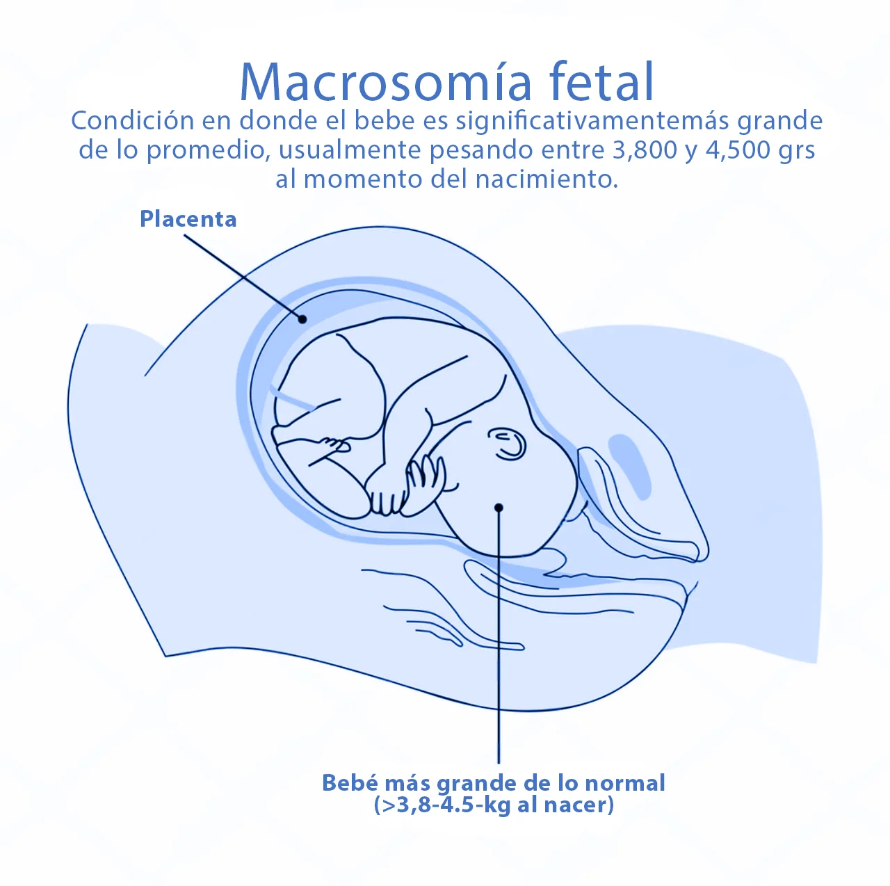 Dibujo que representa la macrosomía fetal, en donde se indican las características del bebé macrosómico. Dibujo que representa la macrosomía fetal, en donde se indican las características del bebé macrosómico.