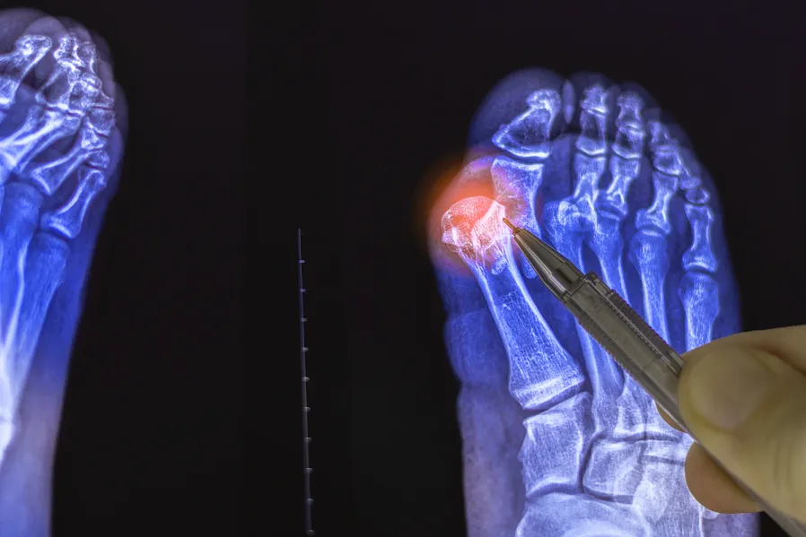 Webinar: Mínima invasión, máxima movilidad: la nueva forma de operar juanetes