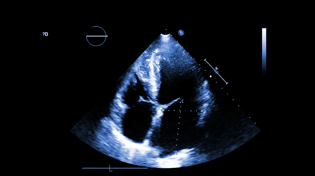 Estudio de ecocardiograma, como estudio de imagen para la detección de los diferentes problemas cardíacos que puede presentar una persona. Estudio de ecocardiograma, como estudio de imagen para la detección de los diferentes problemas cardíacos que puede presentar una persona.