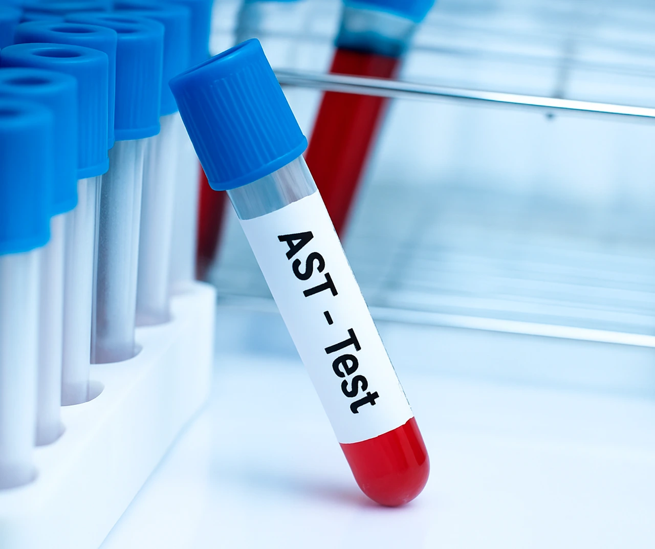 Tubo de ensayo sostenido por una persona para evaluar las pruebas de función hepática en un caso de colestasis intrahepática del embarazo.