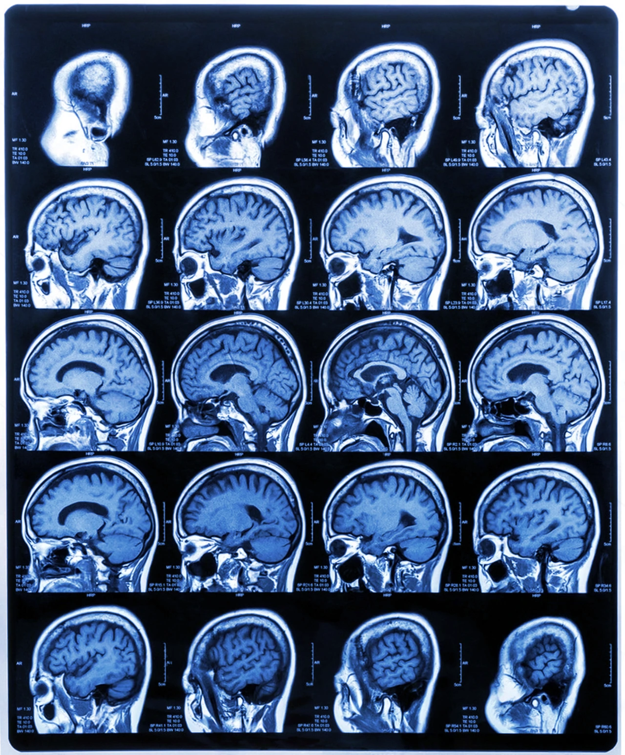 Resonancia magnética de vista lateral para diagnóstico de la enfermedad de Moyamoya. Resonancia magnética de vista lateral para diagnóstico de la enfermedad de Moyamoya.