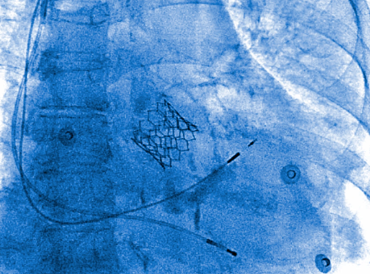 Radiografía, por insuficiencia aórtica, para sustitución valvular por válvula melódica.