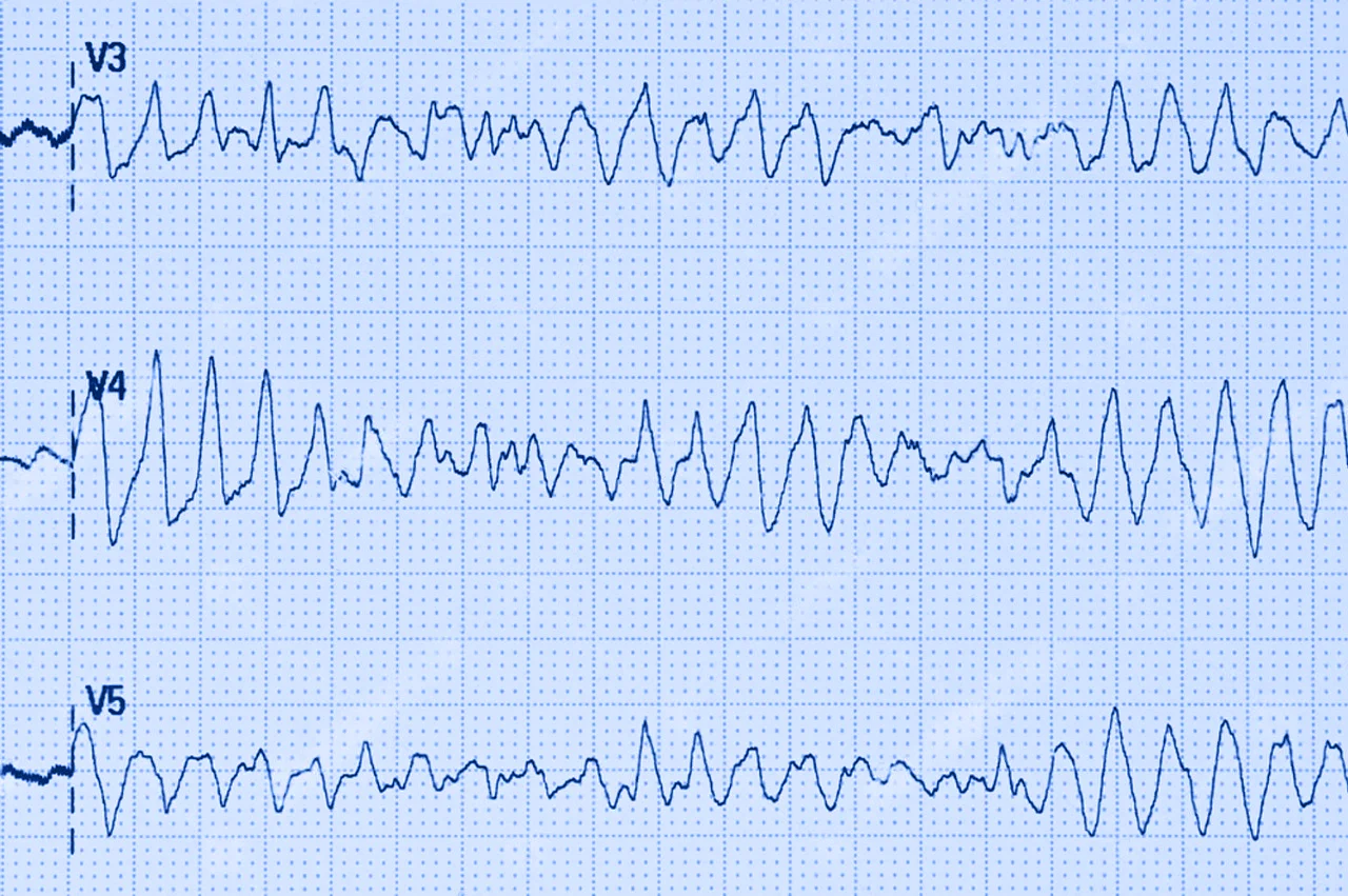 Electroencefalograma que demuestra taquicardia ventricular tipo torsade. Electroencefalograma que demuestra taquicardia ventricular tipo torsade.