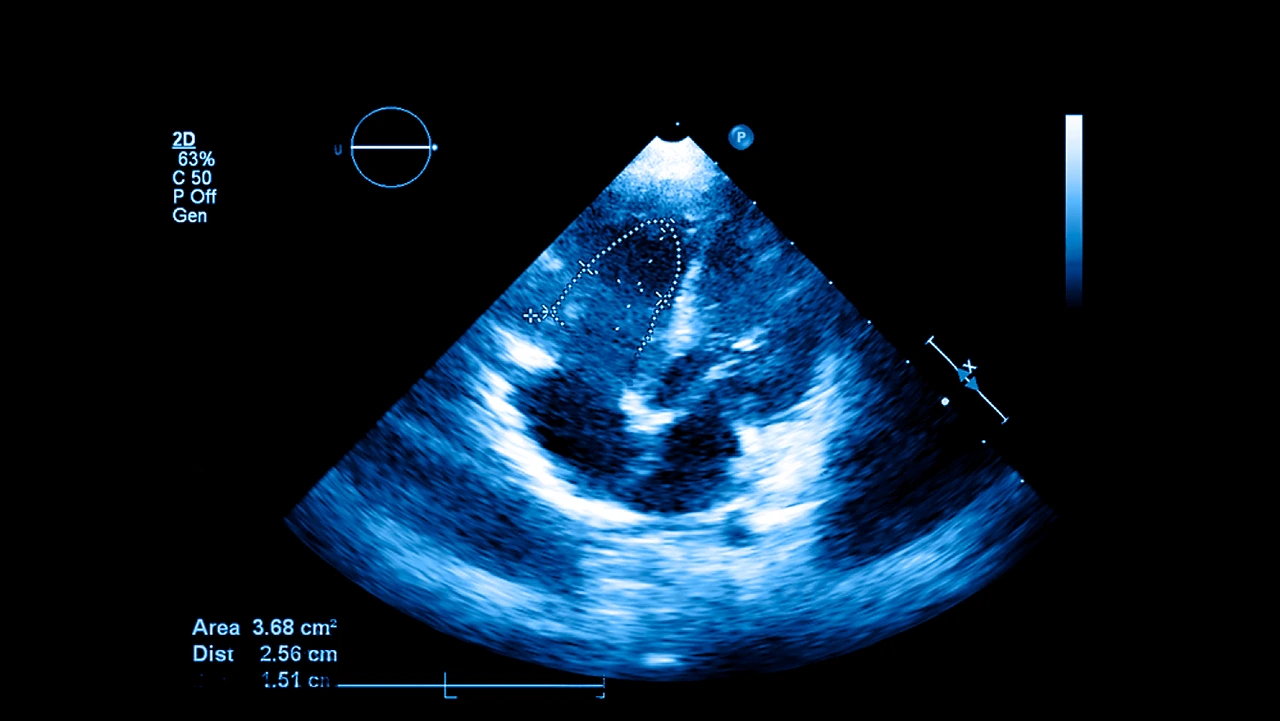 Ecocardiograma del corazón durante un estudio para detectar estenosis pulmonar en un paciente. Ecocardiograma del corazón durante un estudio para detectar estenosis pulmonar en un paciente.