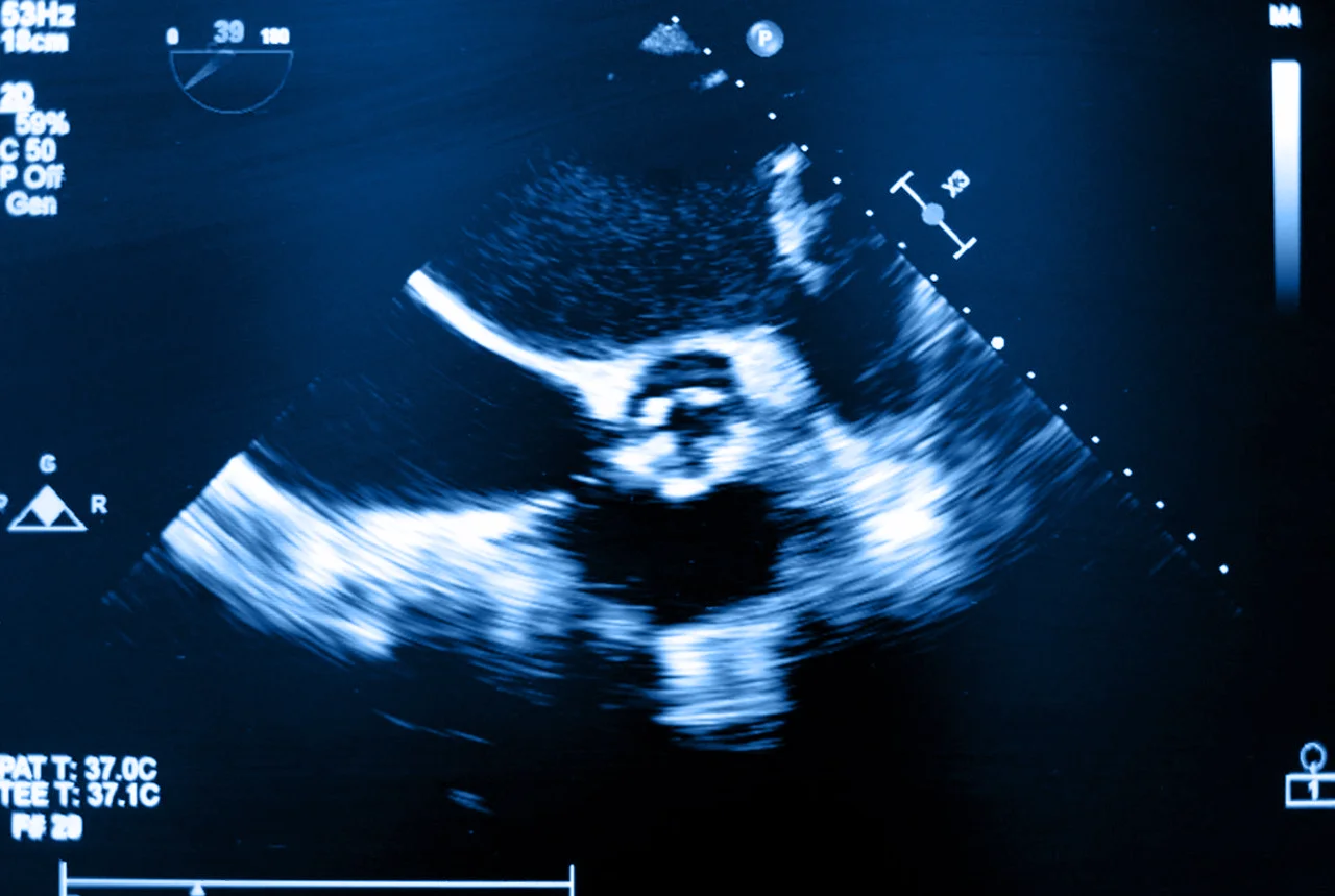 Ecocardiograma transesofágico de la válvula aórtica, para la detección de una posible enfermedad de la válvula aórtica. 