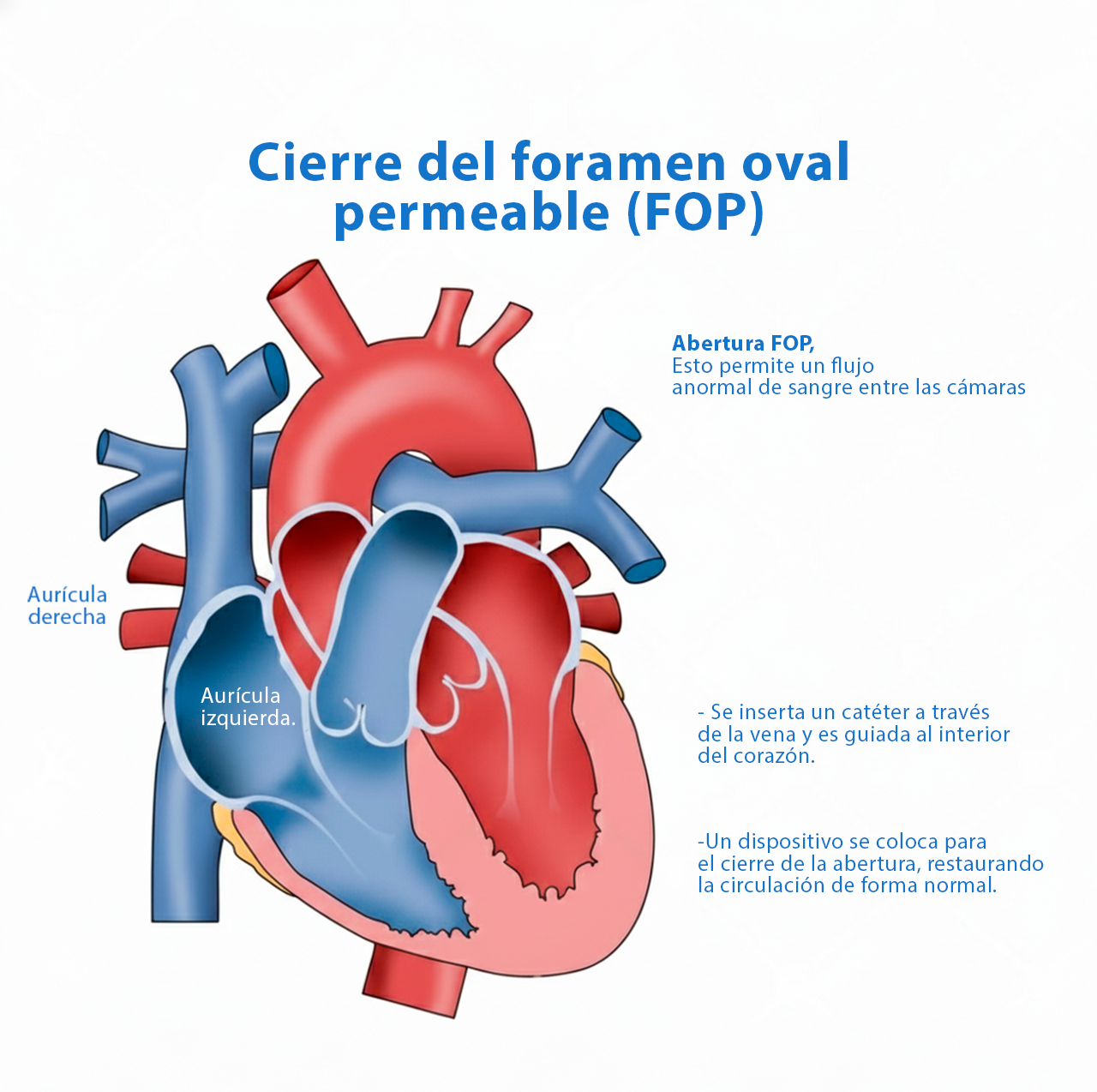 Ilustración de cómo se trata el FOP o foramen oval permeable, mediante el uso de un catéter. Ilustración de cómo se trata el FOP o foramen oval permeable, mediante el uso de un catéter.