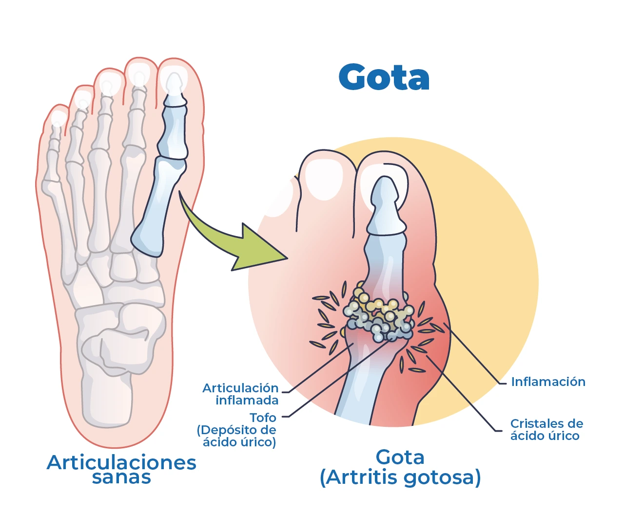 Dibujo en el ácido úrico síntomas, que presentan el desarrollo de la enfermedad de gota y sus características físicas. Dibujo en el ácido úrico síntomas, que presentan el desarrollo de la enfermedad de gota y sus características físicas.