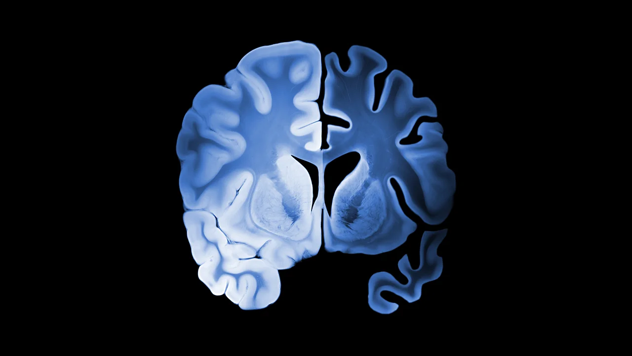 Ilustración del hemisferio izquierdo con Alzheimer, comparándolo con el hemisferio derecho sano de un cerebro. Ilustración del hemisferio izquierdo con Alzheimer, comparándolo con el hemisferio derecho sano de un cerebro.