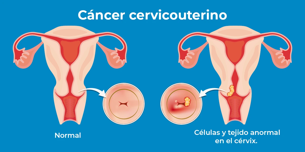 Dibujo comparativo de cómo se ve un útero normal y un útero que ha comenzado a desarrollar cáncer cervicouterino. Dibujo comparativo de cómo se ve un útero normal y un útero que ha comenzado a desarrollar cáncer cervicouterino.