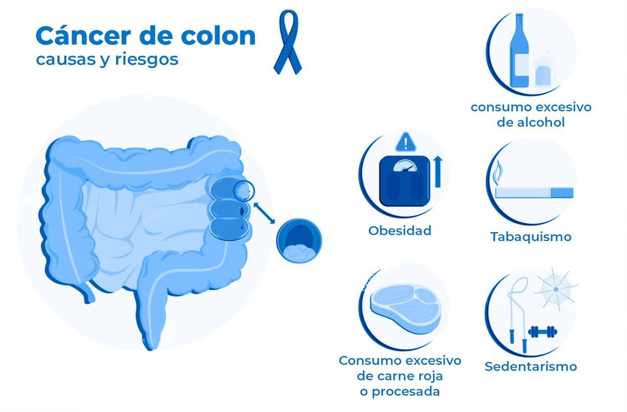 Ilustración sobre los factores de riesgo para desarrollar cáncer de colon incluyendo los hábitos y la alimentación.
