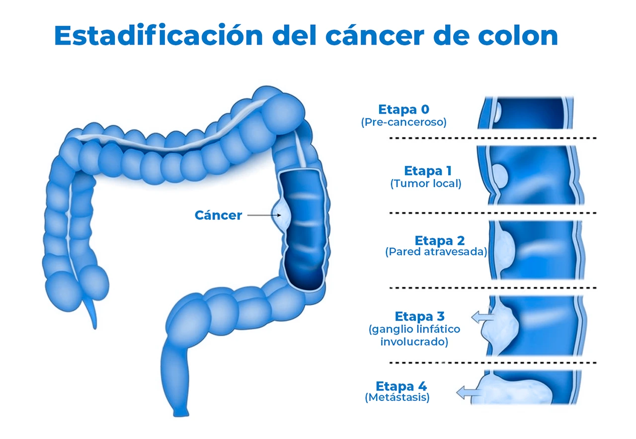 Dibujo del intestino grande, en donde se ejemplifican las diferentes etapas del cáncer de colon para la estadificación. Dibujo del intestino grande, en donde se ejemplifican las diferentes etapas del cáncer de colon para la estadificación.