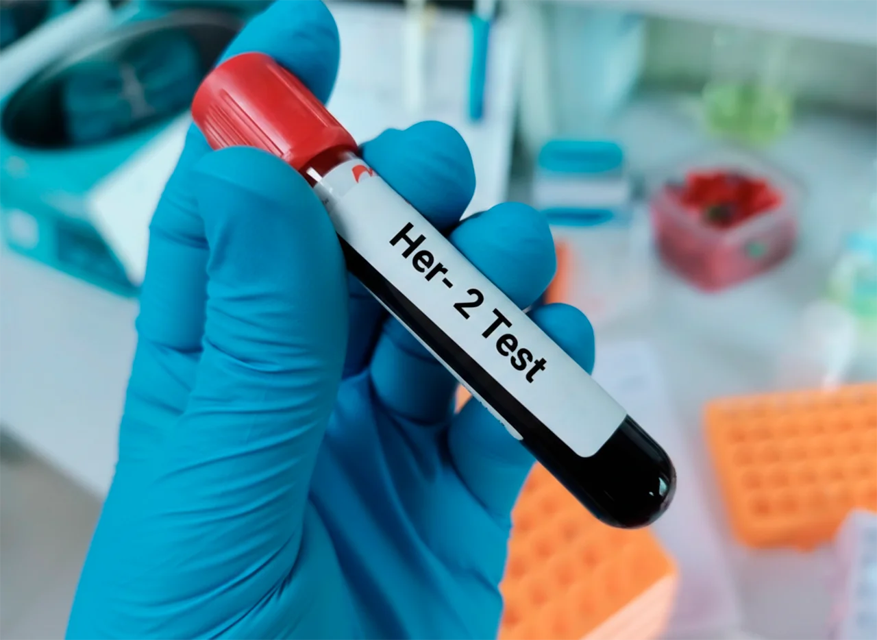 Tubo de ensayo, como parte del proceso diagnóstico de cáncer de mama, con muestra de sangre para el análisis de la proteína HER2. Tubo de ensayo, como parte del proceso diagnóstico de cáncer de mama, con muestra de sangre para el análisis de la proteína HER2.