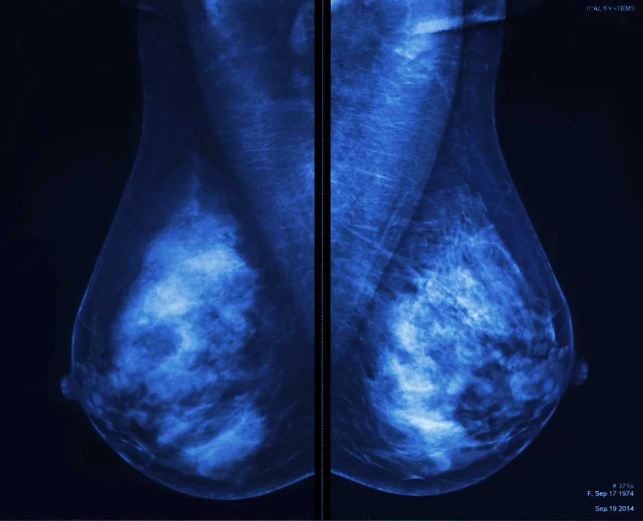 Mastografía de ambas mamas, como parte de los estudios diagnóstico de cáncer de mama en una paciente. Mastografía de ambas mamas, como parte de los estudios diagnóstico de cáncer de mama en una paciente.