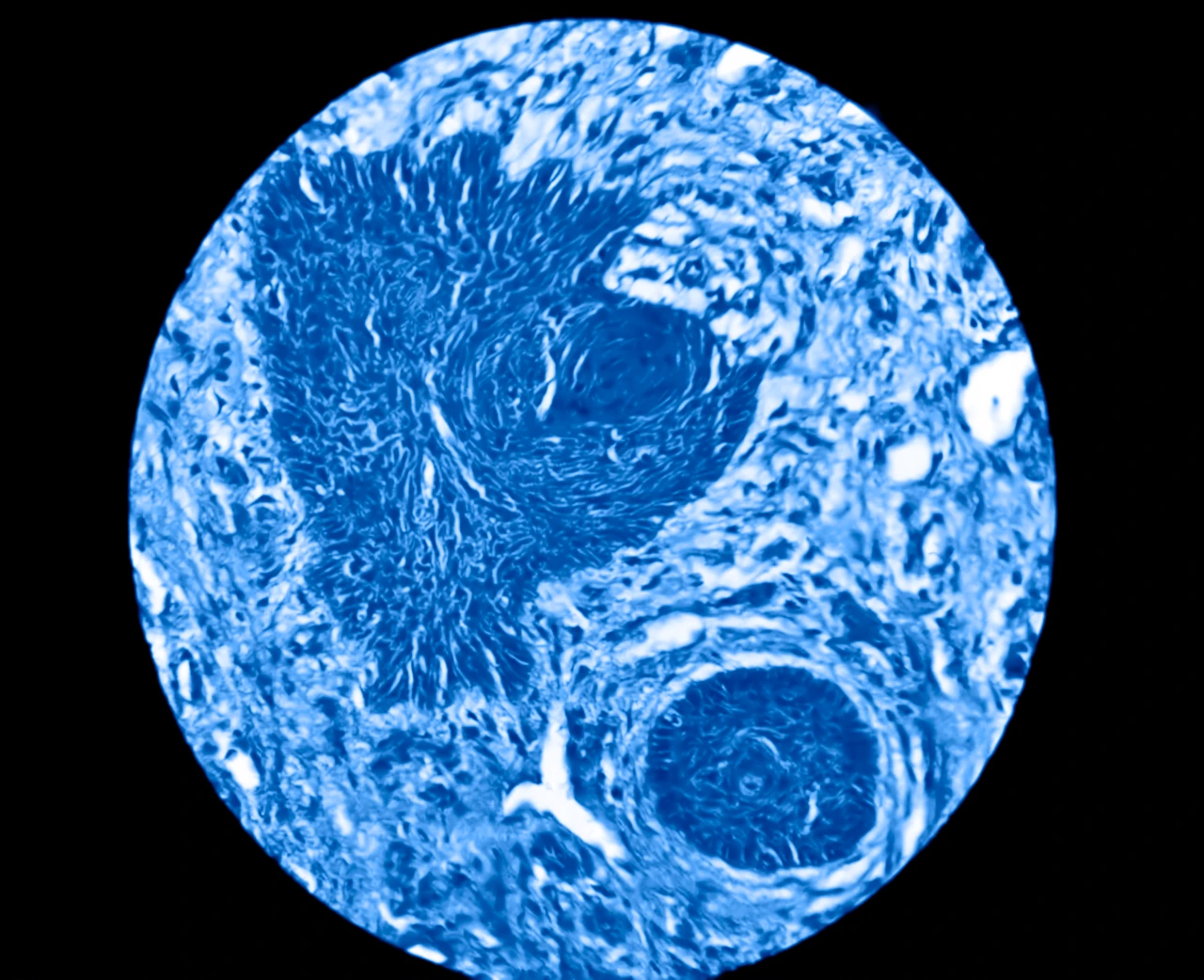 Imagen de una biopsia cutánea para la detección de cáncer de piel, un posible carcinoma basocelular. Imagen de una biopsia cutánea para la detección de cáncer de piel, un posible carcinoma basocelular.