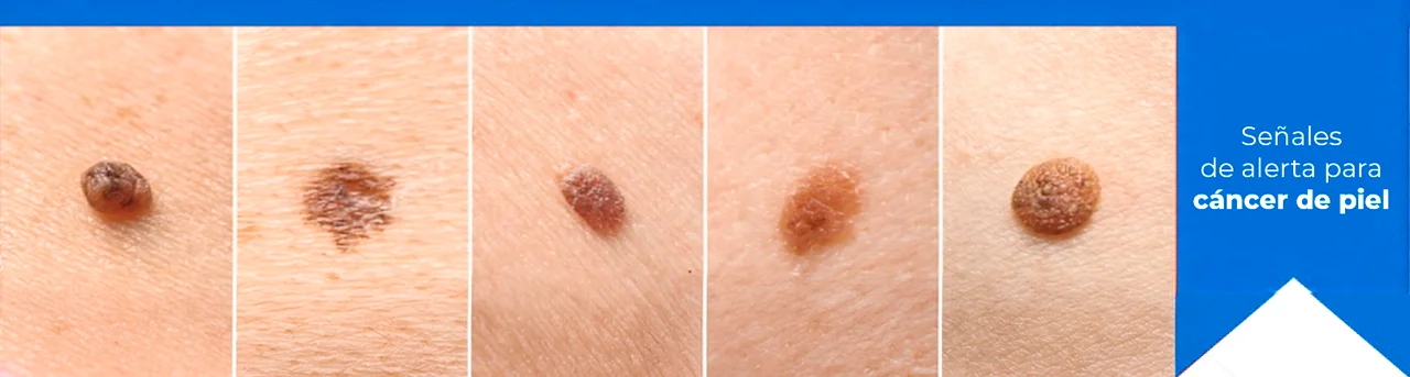 Diferentes fotos de cómo el cáncer de piel se puede presentar, para indicar las señales de alerta. Diferentes fotos de cómo el cáncer de piel se puede presentar, para indicar las señales de alerta.