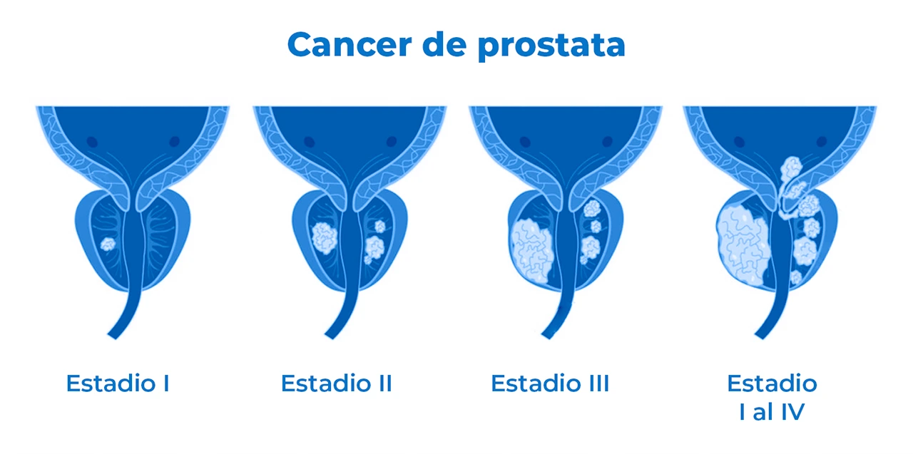 Ilustración que representa las etapas del cáncer de próstata, desde la etapa 1 hasta la etapa 3. Ilustración que representa las etapas del cáncer de próstata, desde la etapa 1 hasta la etapa 3.